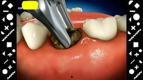 种牙全过程视频