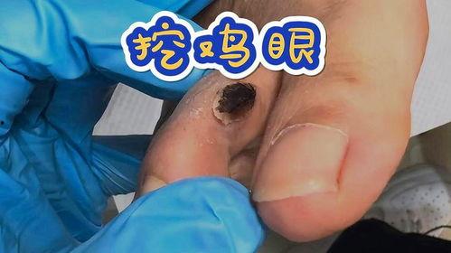 抠鸡眼视频,视频教学助你轻松应对