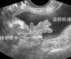 盆腔积液穿刺手术视频,盆腔积液穿刺手术操作步骤及要点解析