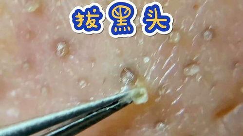 挤黑头的视频大全,视频大全教你轻松除痘
